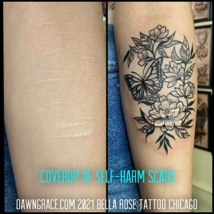 Uncovering Colby Self Harm Scars: Insights And Discoveries For Healing