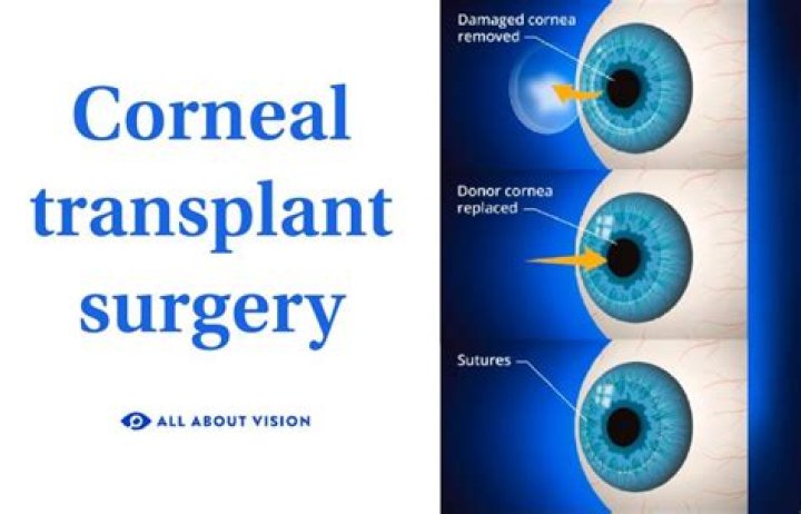 Vision after corneal transplant? r/Keratoconus