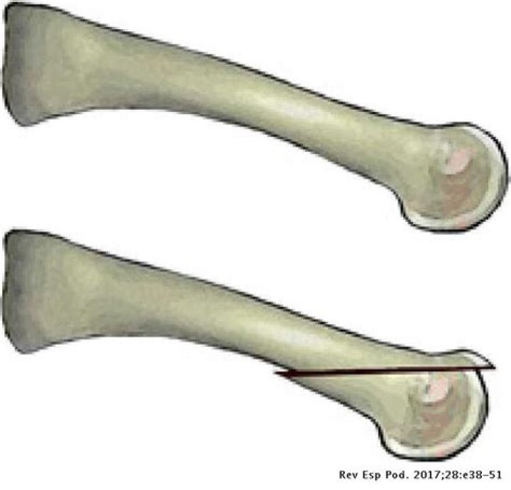W is for the Weil Ostotomy Podiatry ABC Podiatry ABC