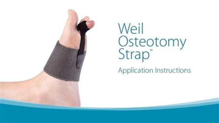 Weil Osteotomy Strap Application Instructions Instruction