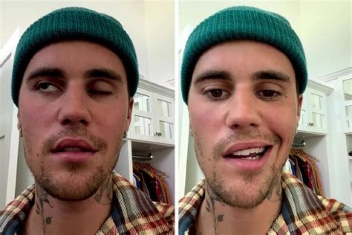 What happened to Justin Bieber's face Facial Paralysis &mdash; Kassir
