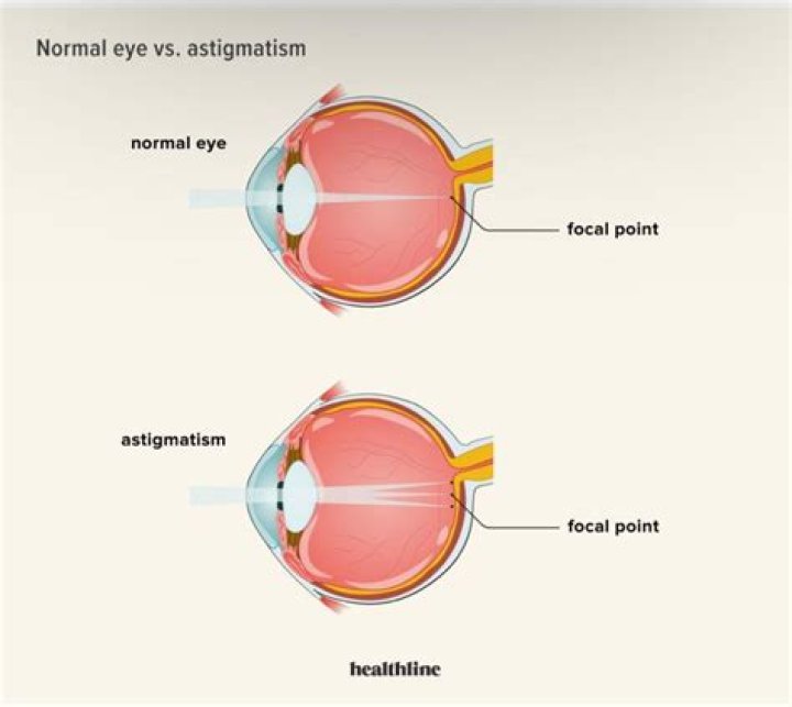 WHAT IS ASTIGMATISM ? Cypress Eye Centre
