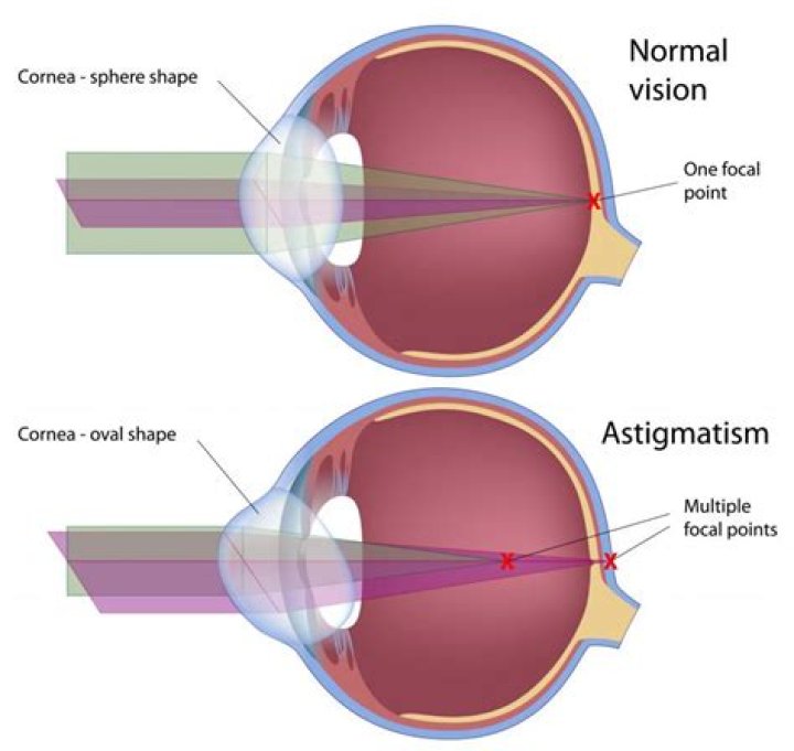 What is Astigmatism? (with pictures)
