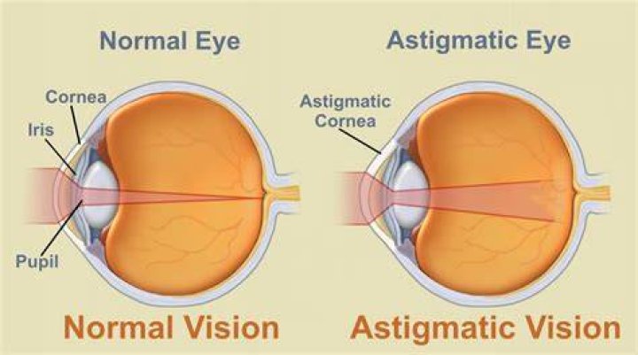 What is Astigmatism?