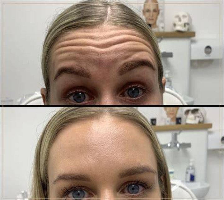 What To Do When Botox Goes Wrong According To Dr. Busso