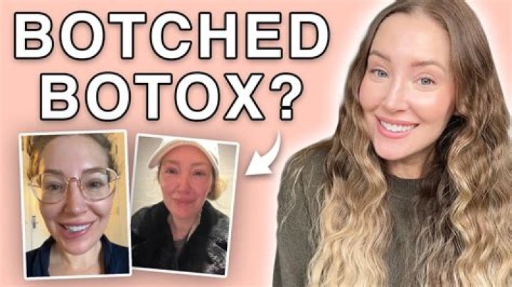 When Botox Goes Wrong YouTube
