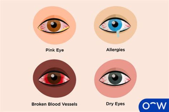 Why are my eyes so red? Forsyth Woman Magazine