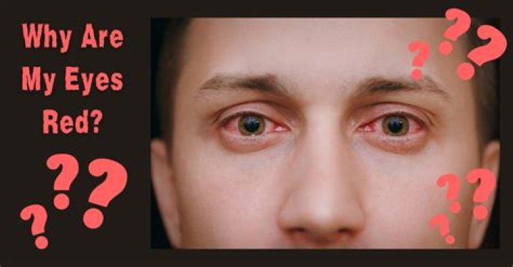 Why Did My Eye Turn Red? Subconjuctival Hemorrhage Patient's Lounge